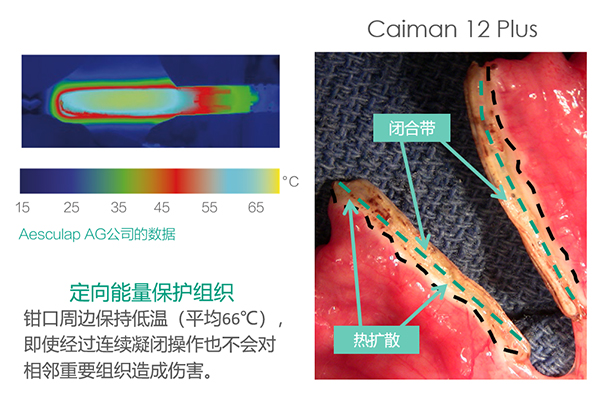 凯门刀手术更安全