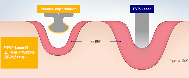 等离子