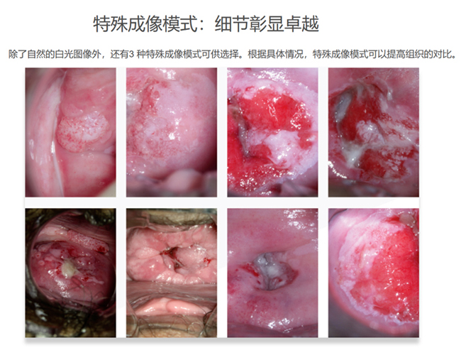 阴道镜拍摄图片展示