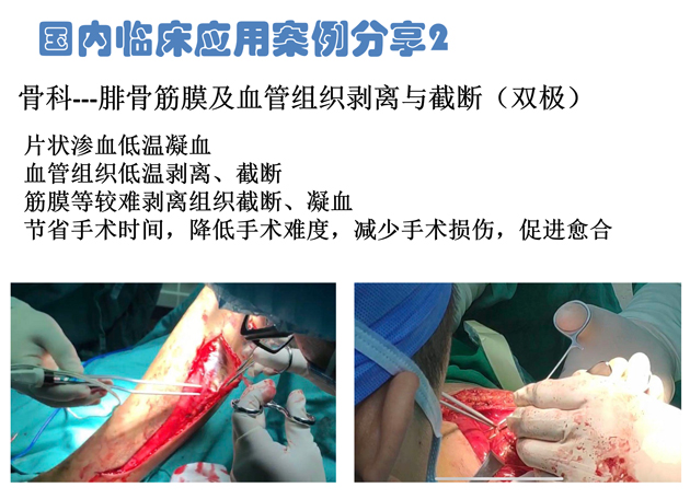 低温射频刀骨科双极应用