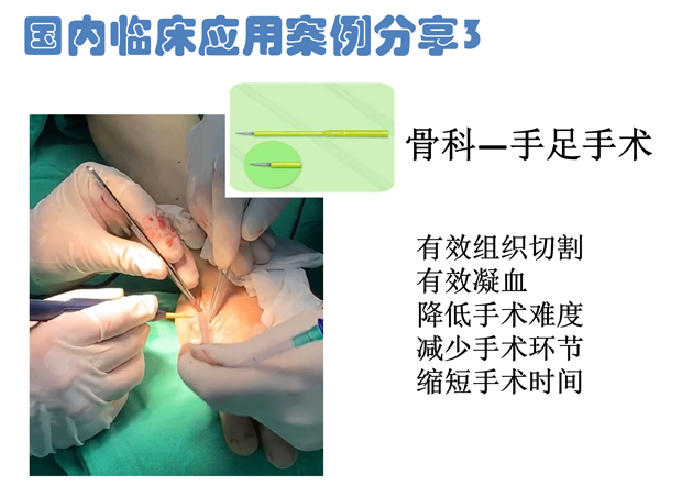 低温射频刀骨科手足手术应用