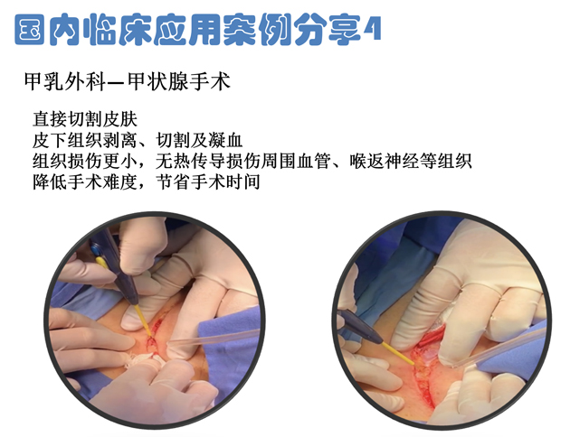 低温射频刀甲乳外科手术应用