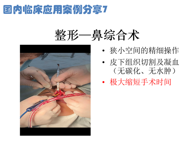 低温射频刀整形鼻综合术应用